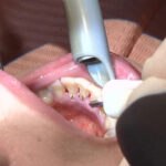 『フェチ』 ガチ歯科治療歯周病？歯肉縁下歯石除去 星野桃子 「DUGA」