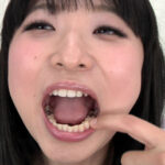 『フェチ』 銀歯インレーフェチ 咲希の口内には銀歯がいっぱい！ 「DUGA」
