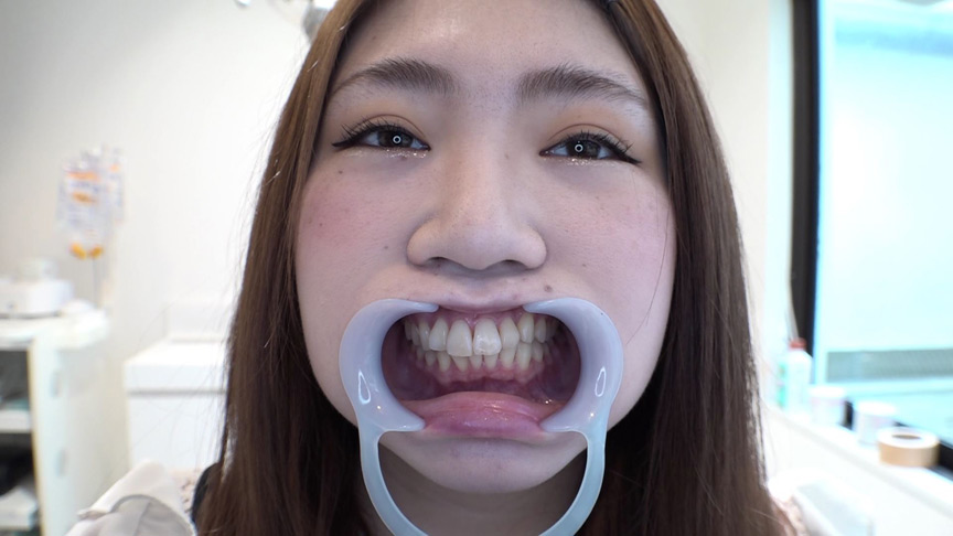『フェチ』 歯フェチ！本物歯科治療映像 親知らず抜歯 芹沢かえで 「D...
