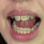 『フェチ』 鼻フック＆開口器 唾ダラ穴剥け歯列矯正娘 「DUGA」