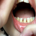 『フェチ』 街角で声をかけて口内観察させてもらう あむちゃん 「DUGA」